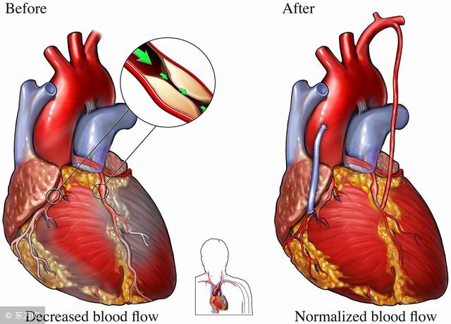 心脏搭桥后血管再狭窄了怎么办如何避免