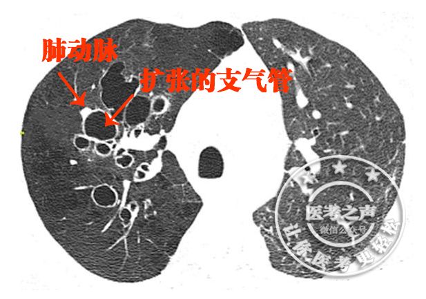 成4层)扩张的支气管就像一个瓦罐痰液就存留在扩张的支气管内就相当于