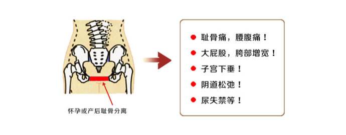 產後媽媽進行骨盆修復有必要嗎有用嗎