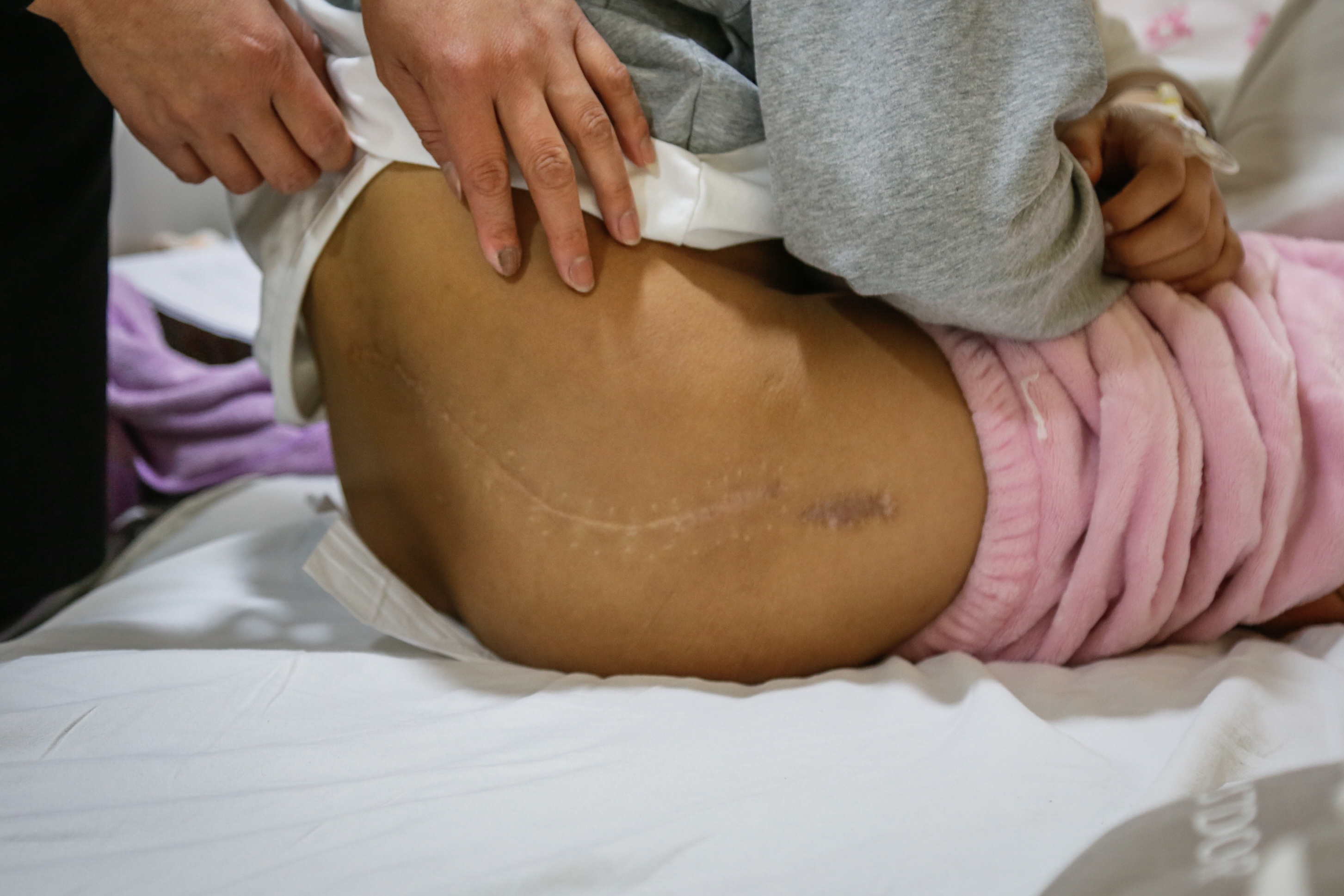 14岁女孩患恶性瘤穿纸尿裤6年放化疗达59次