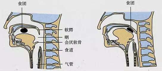 居家康復腦卒中病人如何進行吞嚥障礙的康復訓練