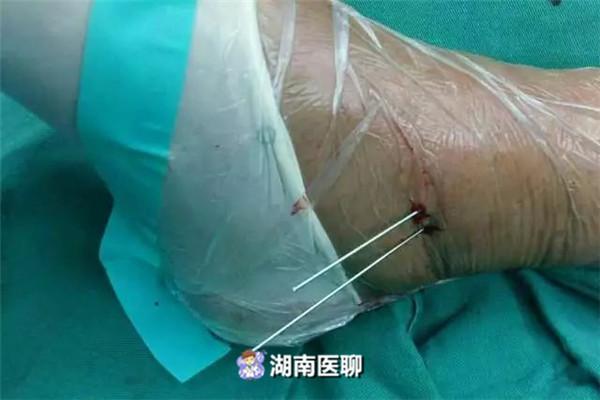 湖南男子腳踝骨折手術不開刀螺釘植入僅靠2個小孔