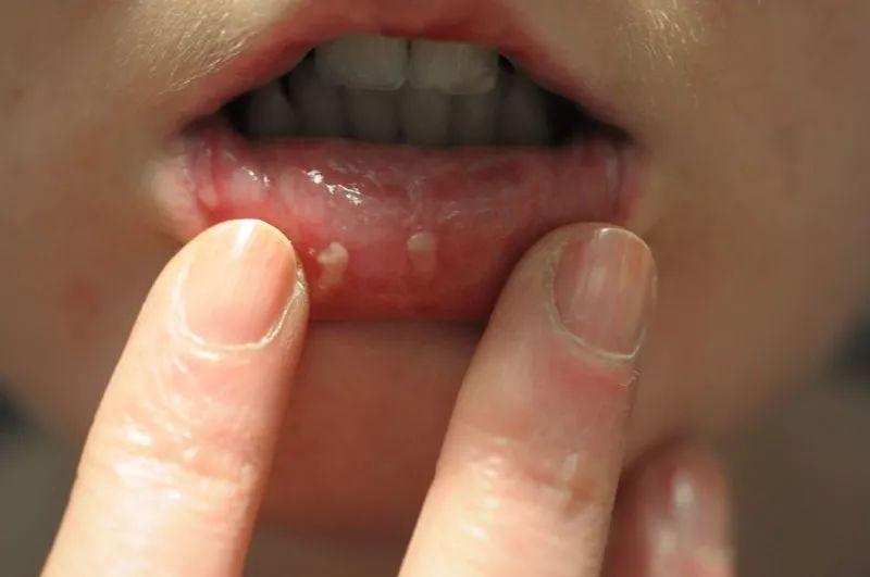 并经许多流行病学研究证实嚼食槟榔与口腔癌有密切关系