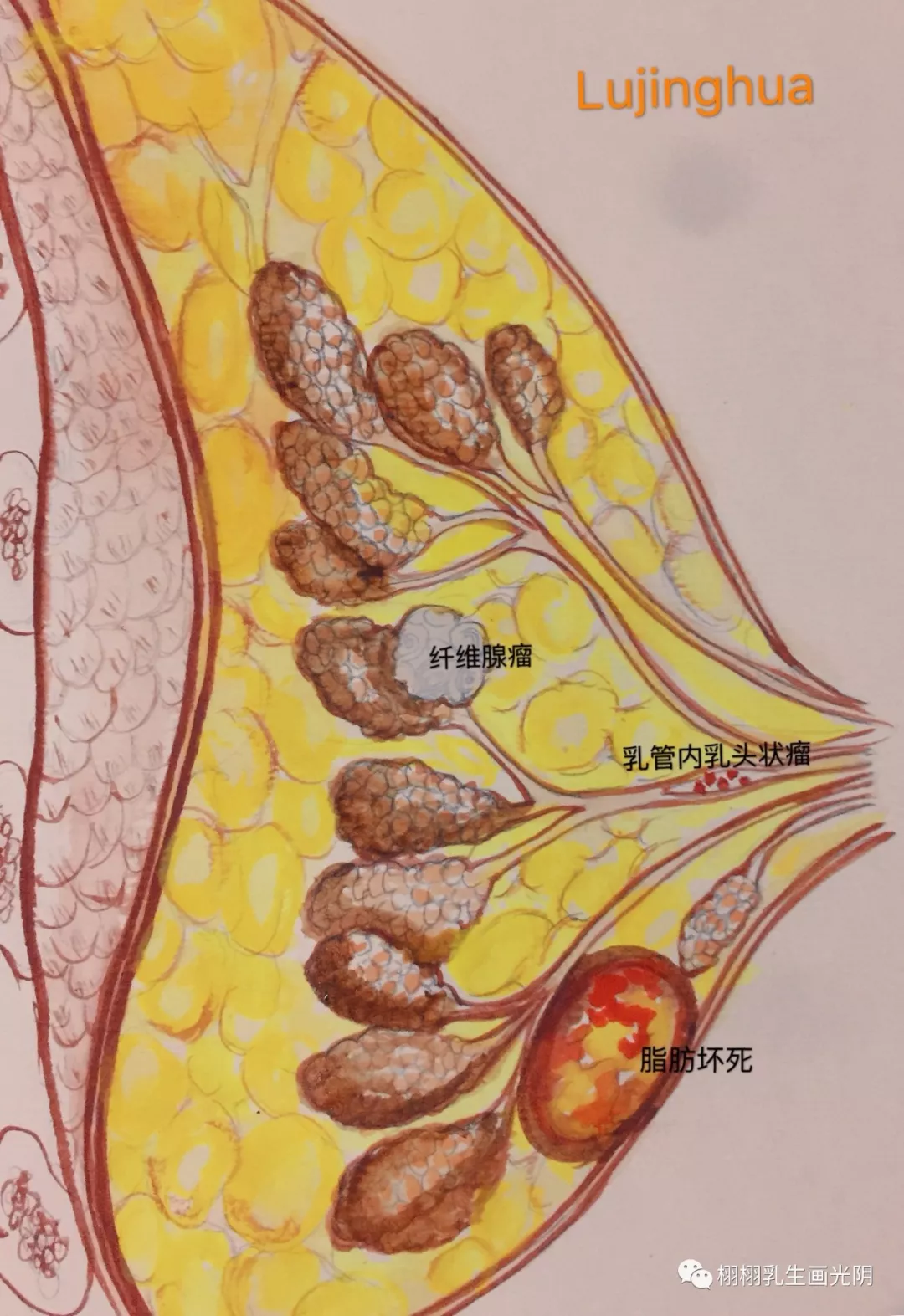 带你走进乳房手绘水彩图解乳房良性疾病