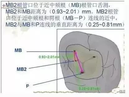 牙髓鈣化是牙髓受到外界刺激的病理改變過程,鈣化程度與不同刺激有關