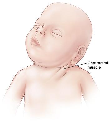 为什么宝宝睡觉总是歪脖子? 如果家长不干预可能会有严重后果