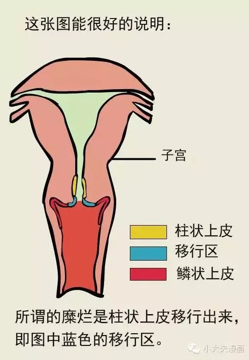 宫颈口撕裂位置图片图片