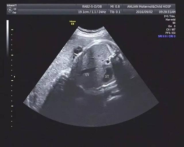28周胎儿彩超图片