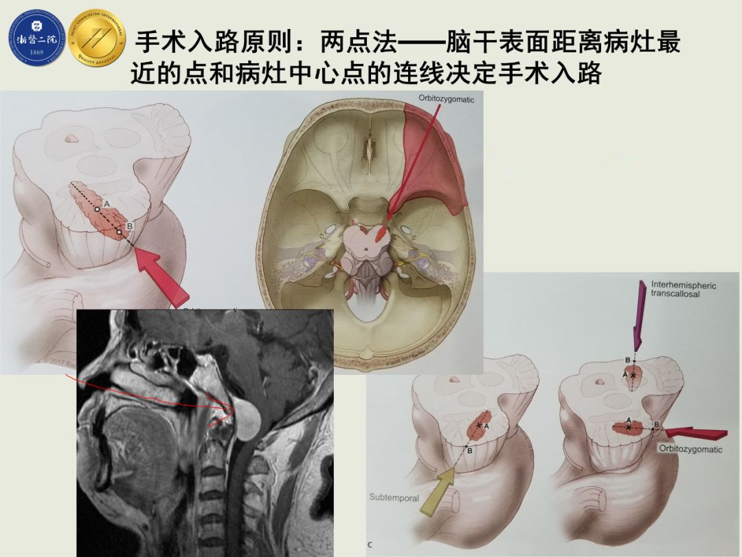 多發粘液性動脈瘤一例浙二神外週刊(一百三十九)--創傷性腦膜中動脈假