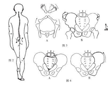 骨盆旋移综合征图片