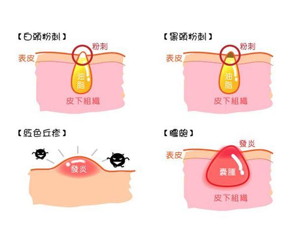 每月下巴总爆痘7个痘痘位置透露身体状况