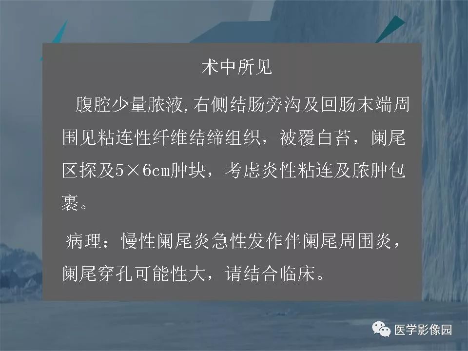 闌尾炎的ct診斷