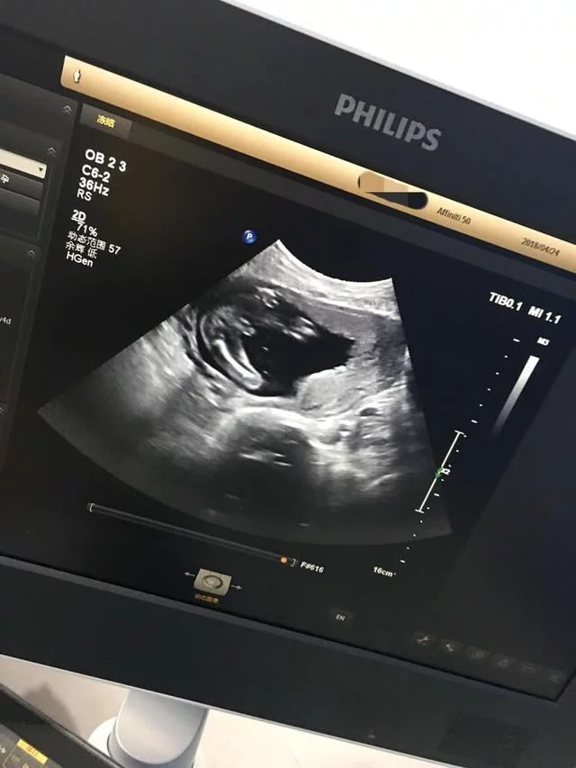 怀孕男宝阴囊图片图片