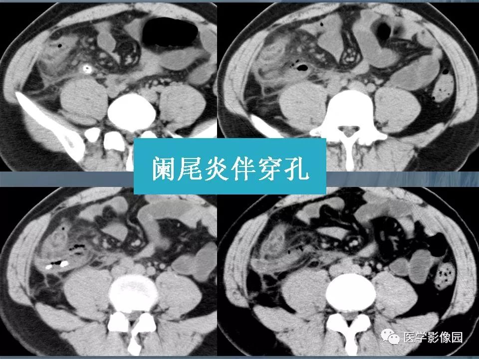 急性阑尾炎ct表现图片图片