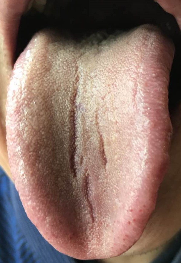 糖尿病患者的舌苔图片图片