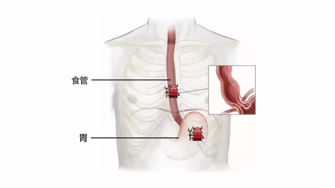 科普食管胃双原发癌的手术治疗