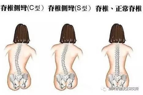 腰突伴随曲度变直或脊柱侧弯的最佳保守治疗方法
