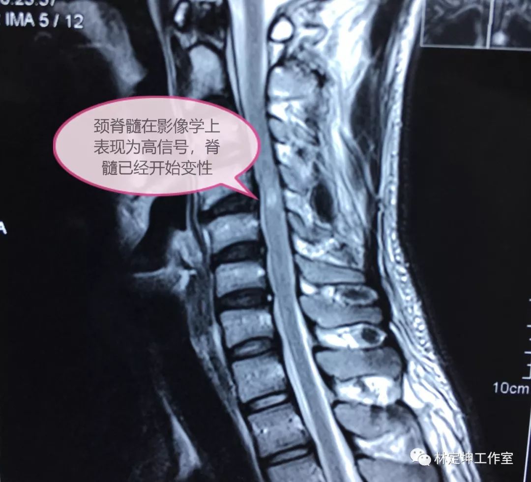 脊髓型颈椎病症状图片