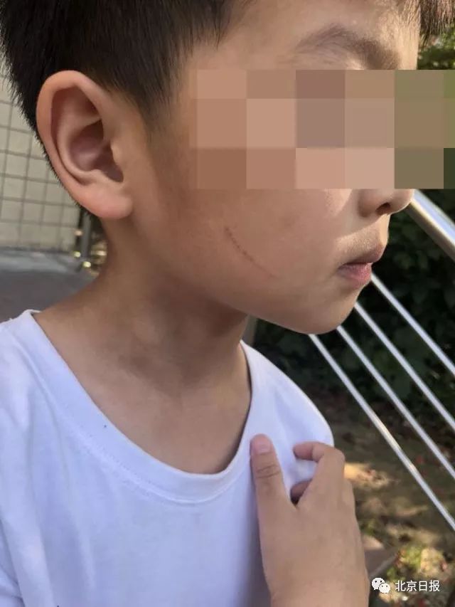 幼儿园多名孩子被老师用笔划伤,戳伤脸部,到底怎么回事?