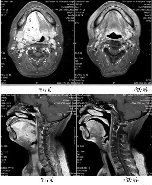 舌癌核磁共振报告图片图片