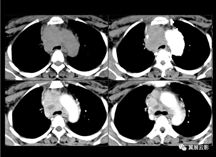 胸腺類癌ct診斷與鑑別診斷