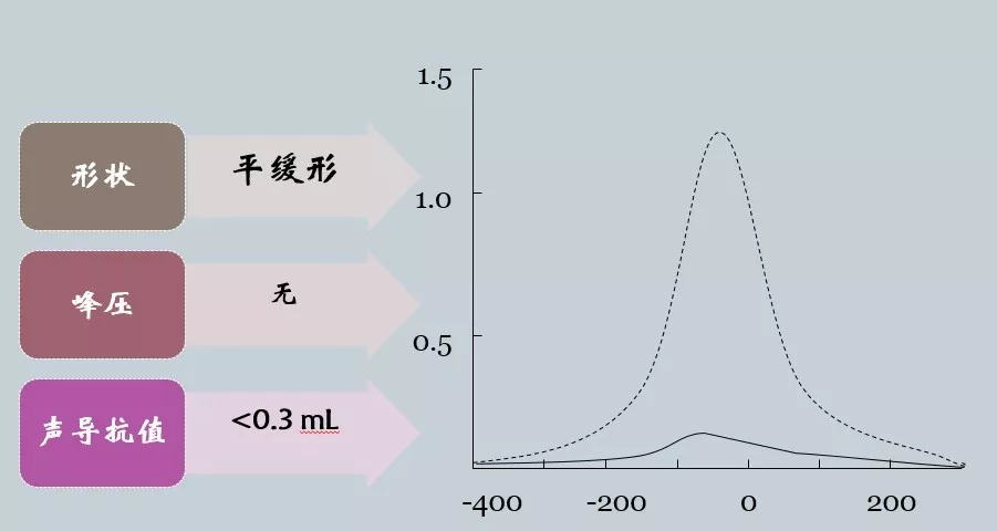 聽力知識鼓室聲導抗科普篇