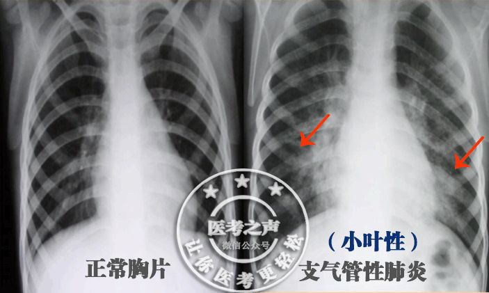 就像几串葡萄所以,小叶性肺炎又叫支气管性肺炎看图引起细支气管以及