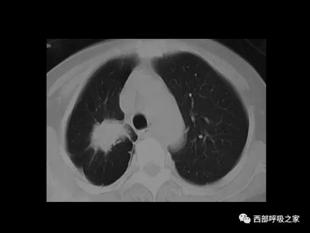肺癌的ct诊断