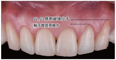 牙龈位置图片图片