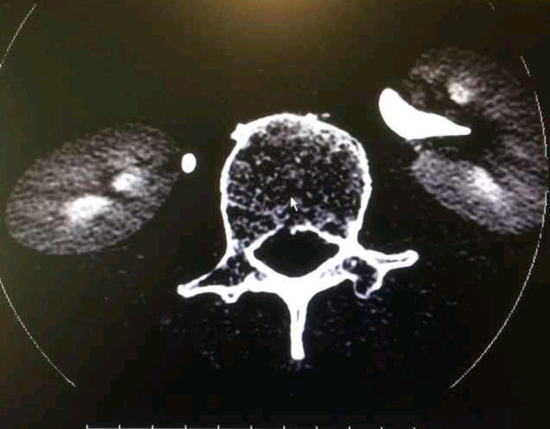 輕盈醫學頸椎病腰椎管狹窄伴反覆腰痛與跛行為何