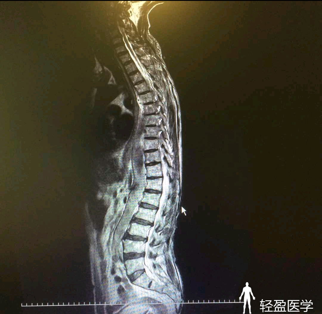 輕盈醫學頸椎病腰椎管狹窄伴反覆腰痛與跛行為何