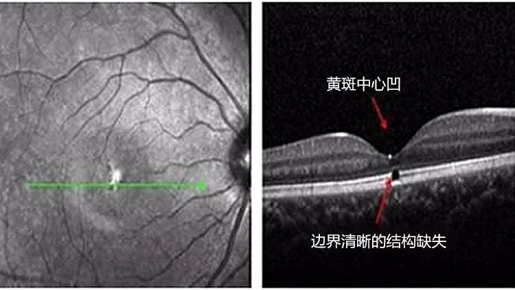 (激光笔导致黄斑区永久损伤示意图)