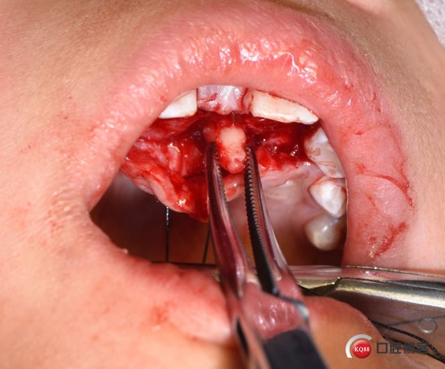 用小弯取出可见取出的牙齿选择仰角手机和加长裂钻(球钻更好)根据口腔