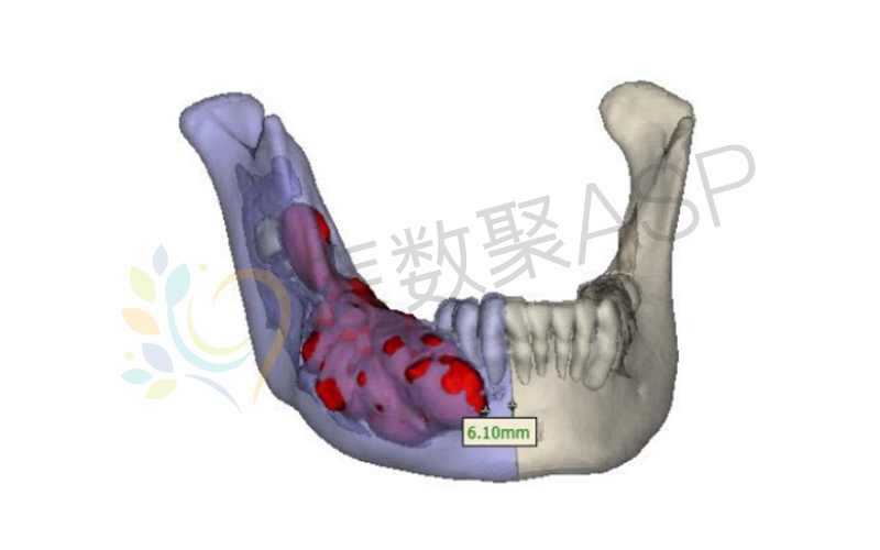 成釉细胞瘤手术图片