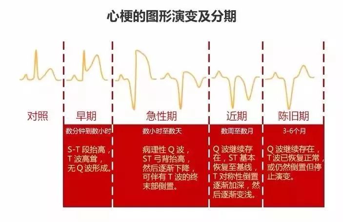 异常心电图,这样看秒懂!