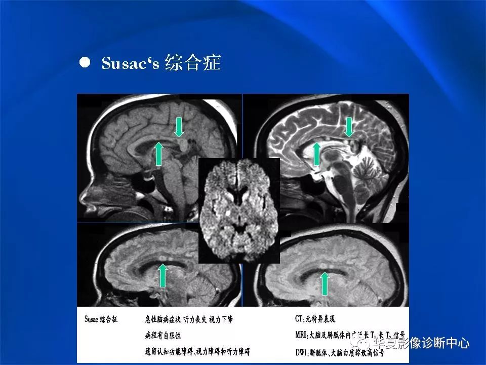 胼胝体解剖及各种病变的影像学表现