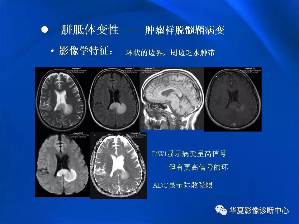 胼胝体解剖及各种病变的影像学表现