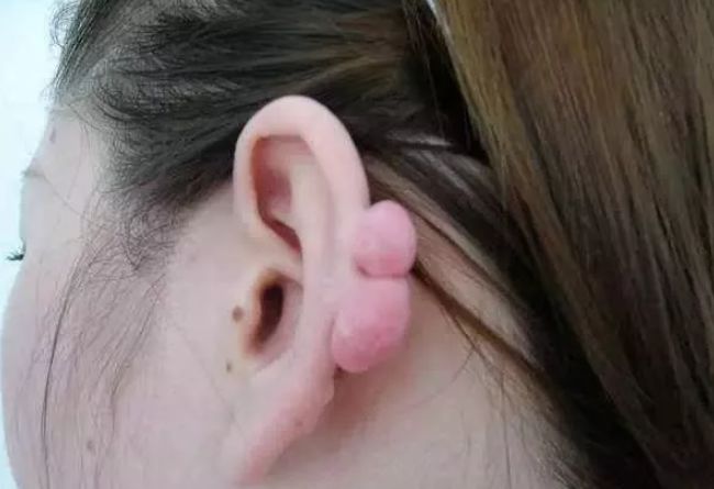 金沙人警惕女子左耳打了四个耳洞一年后耳朵竟然长出了两个球