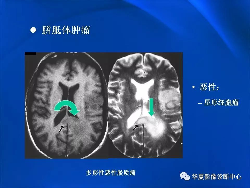 胼胝体解剖及各种病变的影像学表现