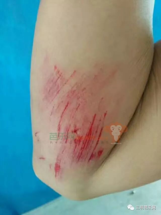 骑车摔倒伤口流血图片图片