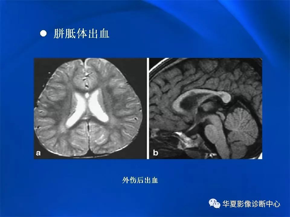 胼胝体解剖及各种病变的影像学表现