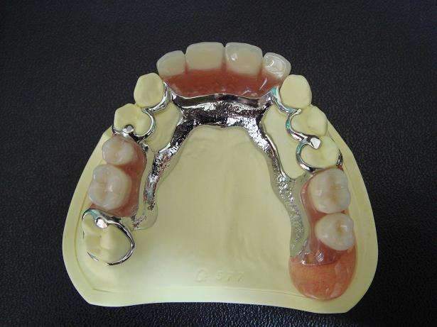 2,固定桥修复是能恢复牙体的形态功能,抗折力强,耐磨性强,不变形,色泽