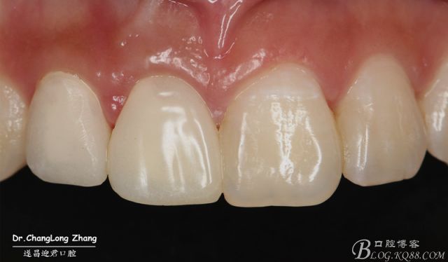 11,12根管治療 纖維樁 氧化鋯全瓷11與21牙齦高度不一致