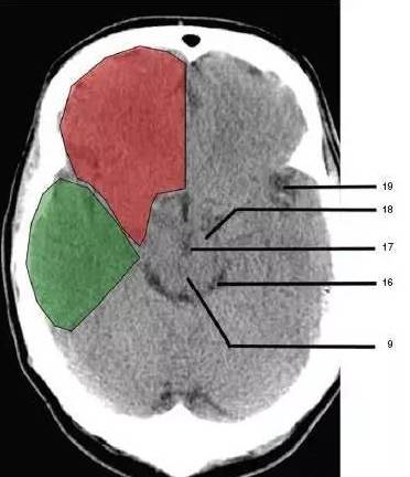 顱腦ct詳解到這份上再說忘記不可能