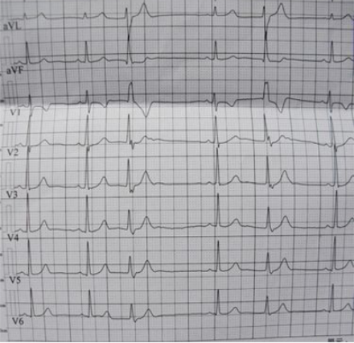 窦性心律不齐在心电图上有什么样的表现?