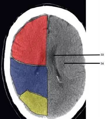 lobe,黄色部分为枕叶(occipital lobe,褐色部分为顶叶(parietal