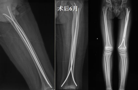 側股骨頸合併股骨幹骨折病理性骨折的預防性固定骨不連與畸形癒合case