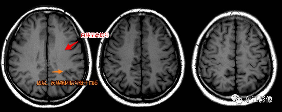 图5图6大脑镰脂肪化与成熟的骨化mri信号并不容易区分,反而ct比较直观
