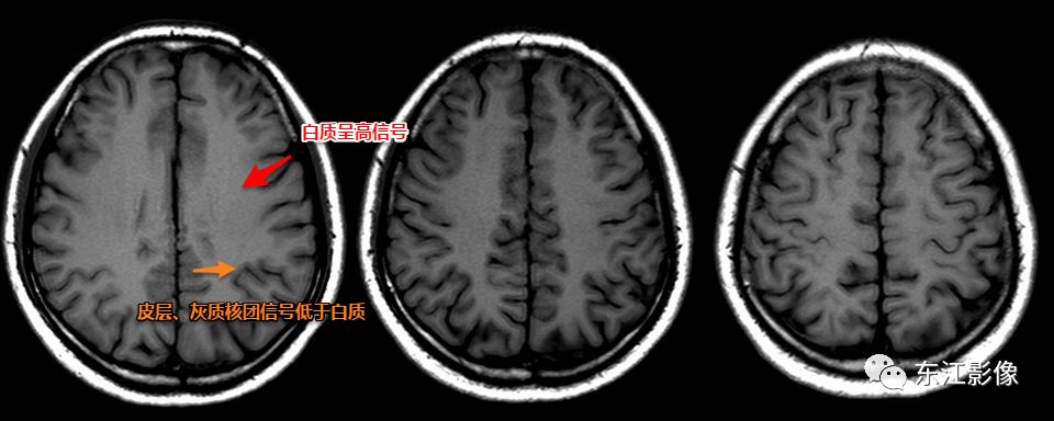 脑灰质与脑白质影像图图片