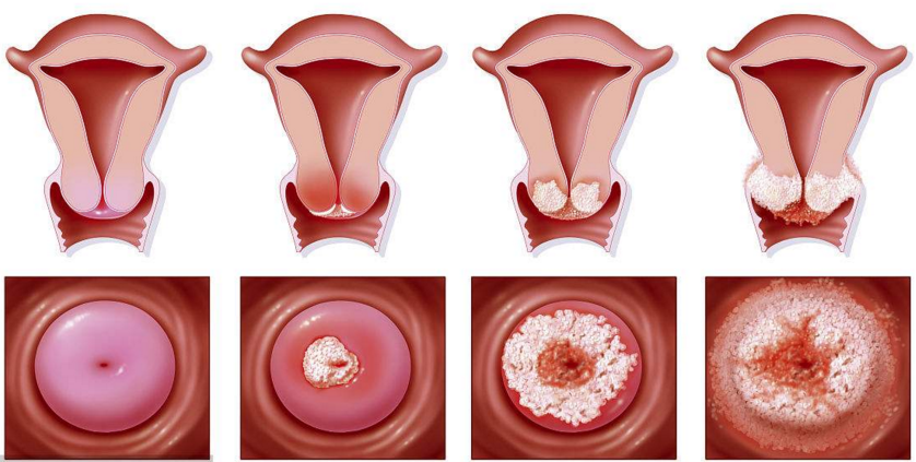 宫颈癌早期黄水 初期图片
